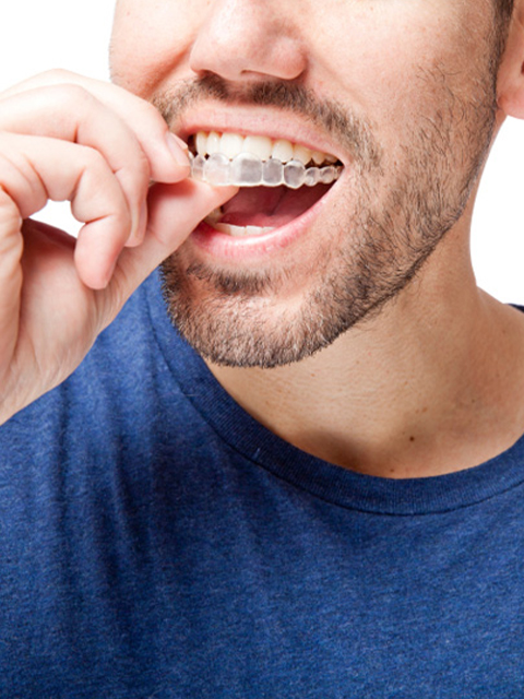 invisalign faqs